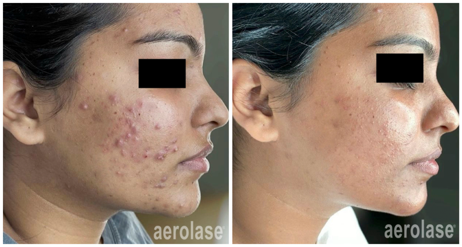 Neoderm by Aerolase